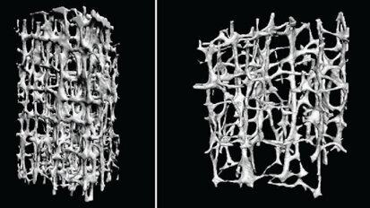 Osteoporosis and bisphosphonates