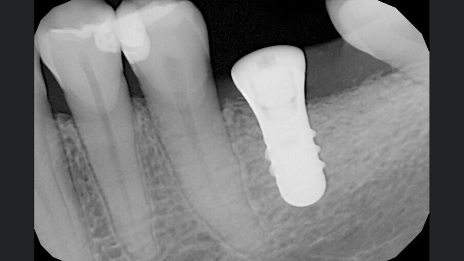 Fig. 7 - RX post-operatoria.