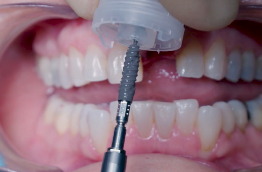 Fig. 9_Implant pick-up. 
