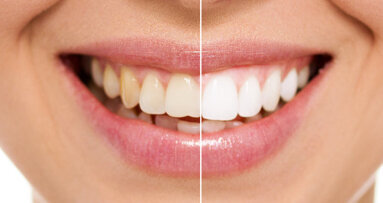Man fined £11,500 for providing illegal tooth whitening and training