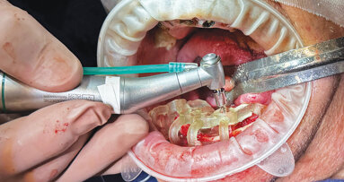 Precision and predictability with NeoBiotech’s NaviGuide Guided Surgery System