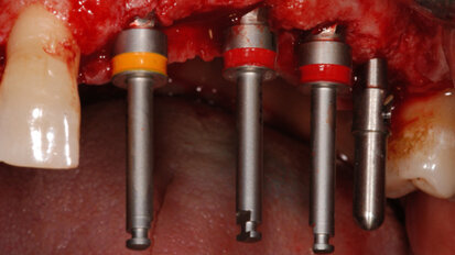 Riabilitazione di un caso complesso con impianti in zirconia