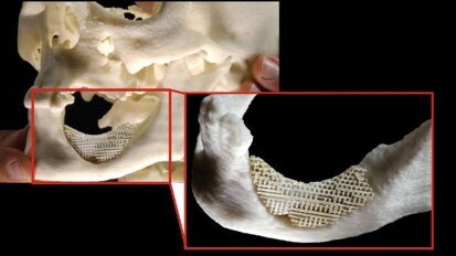 Учени от Норвегия разработват матрица за лечение на тежки костни дефекти
