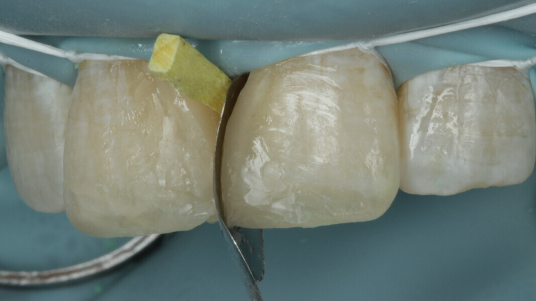 Fig 15. And the proximal contour Is built for the left central.
