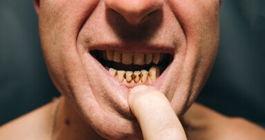 Cost drives unmet dental care needs across the EU