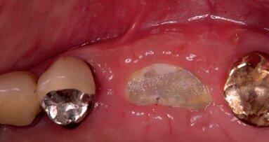 Procedure mininvasive d’aumento e preservazione alveolare (open barrier membrane technique)