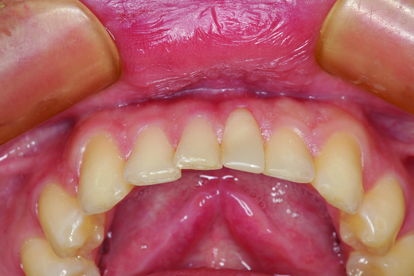 Fig. 9: Incisal view of the direct composite restoration of tooth #41, showing the incisal edge alignment compared with the pre-op situation (Fig. 3).
