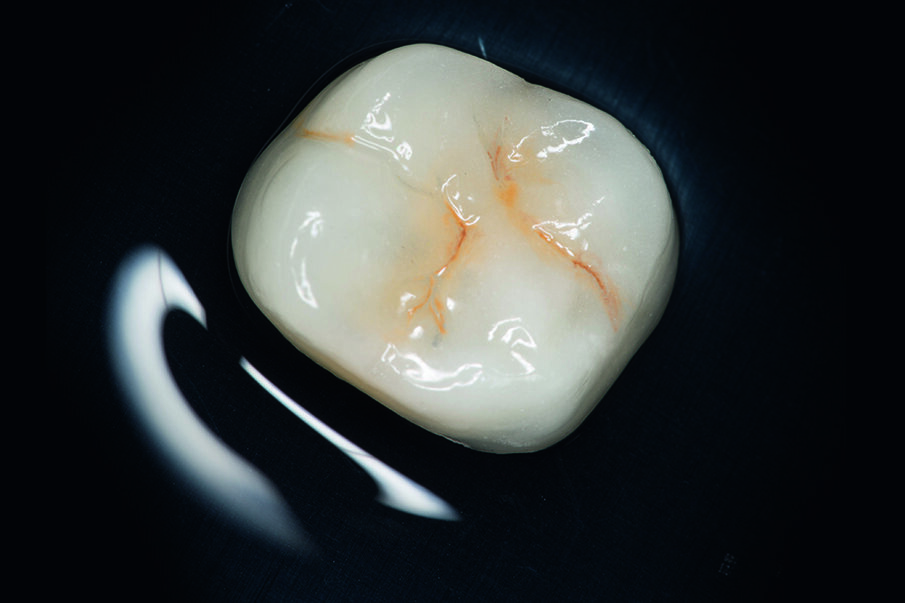 Fig. 8: The ceramic crown was etched with hydrofluoric acid. 