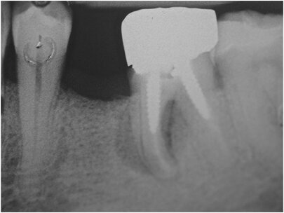 Fig. 1 - Radiografia endorale. L’elemento 3.6 è compromesso a causa di una frattura e deve essere estratto.