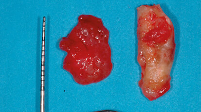 La tecnica di preservazione crestale associata alla chirurgia guidata per la sostituzione di un dente gravemente compromesso