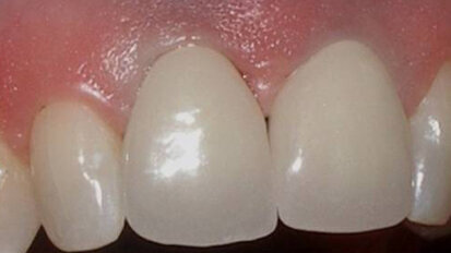 Zirconium dioxide implant solutions: A metal-free option