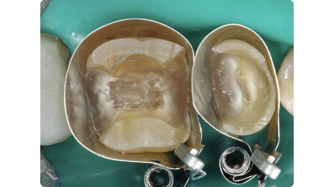 Fig. 9: Isolation of the operating field and positioning of two matrices to perform both pre-endodontic reconstructions after removal of the infected tissue.