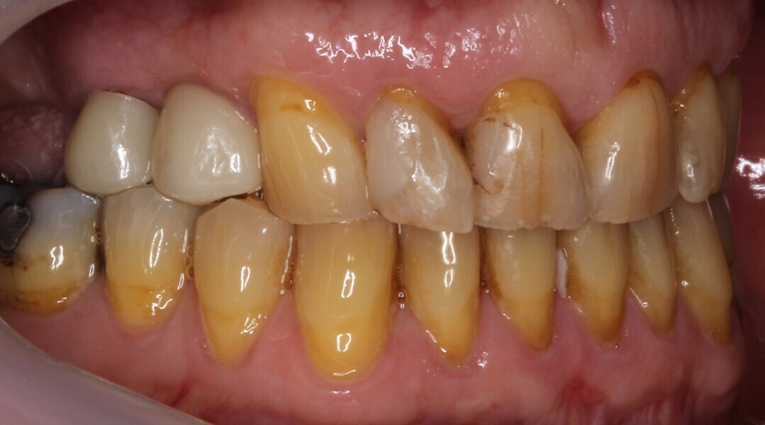 Fig. 22: Zirconia crowns in situ.