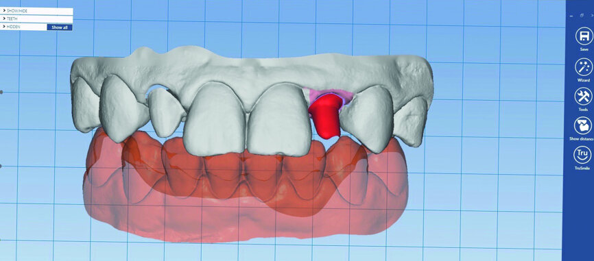 Fig. 17: The final restorations were designed in Planmeca PlanCAD Premium.