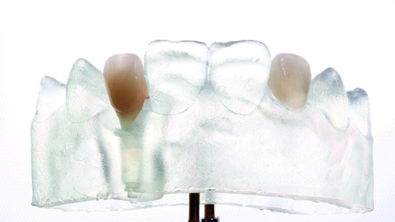 The complete digital implant  workflow
