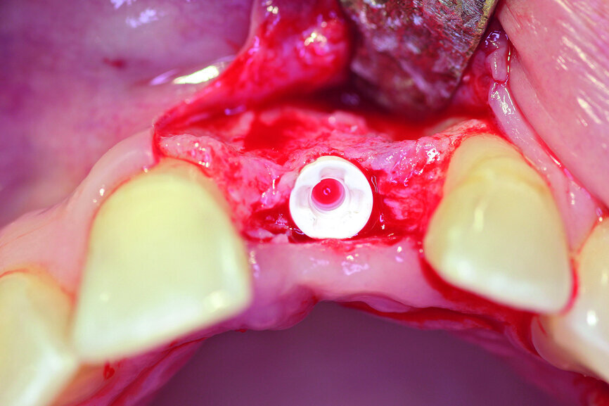 Fig. 5b: A two-piece ceramic implant was inserted.