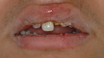 Reconstrucción inmediata de dientes con destrucción avanzada