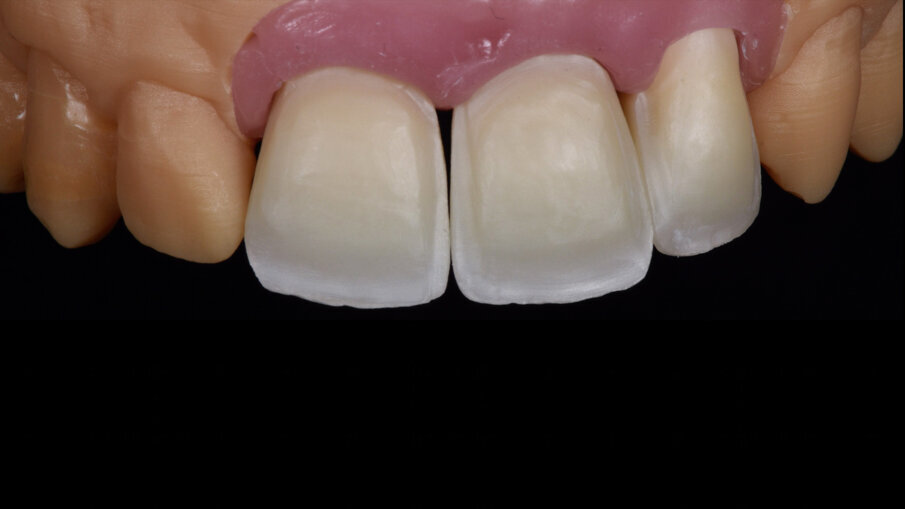 Fig. 7_Struttura definitiva in zirconia SHOFU Supra con riduzione vestibolare. 