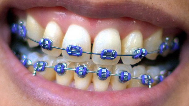 Orthodontieverzekering de moeite waard