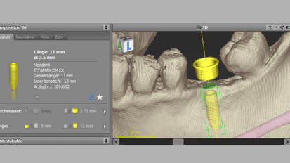 Dental-Wings-Software coDiagnostiX jetzt mit Neodent-Implantaten