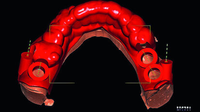 Comparison of guided and non-guided implant placement accuracy (Part 1)