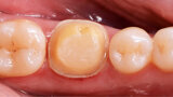 Fig. 2. Situación después de la reconstrucción del muñón con resina (Tetric N-Ceram Bulk Fill) y la preparación del muñón.
