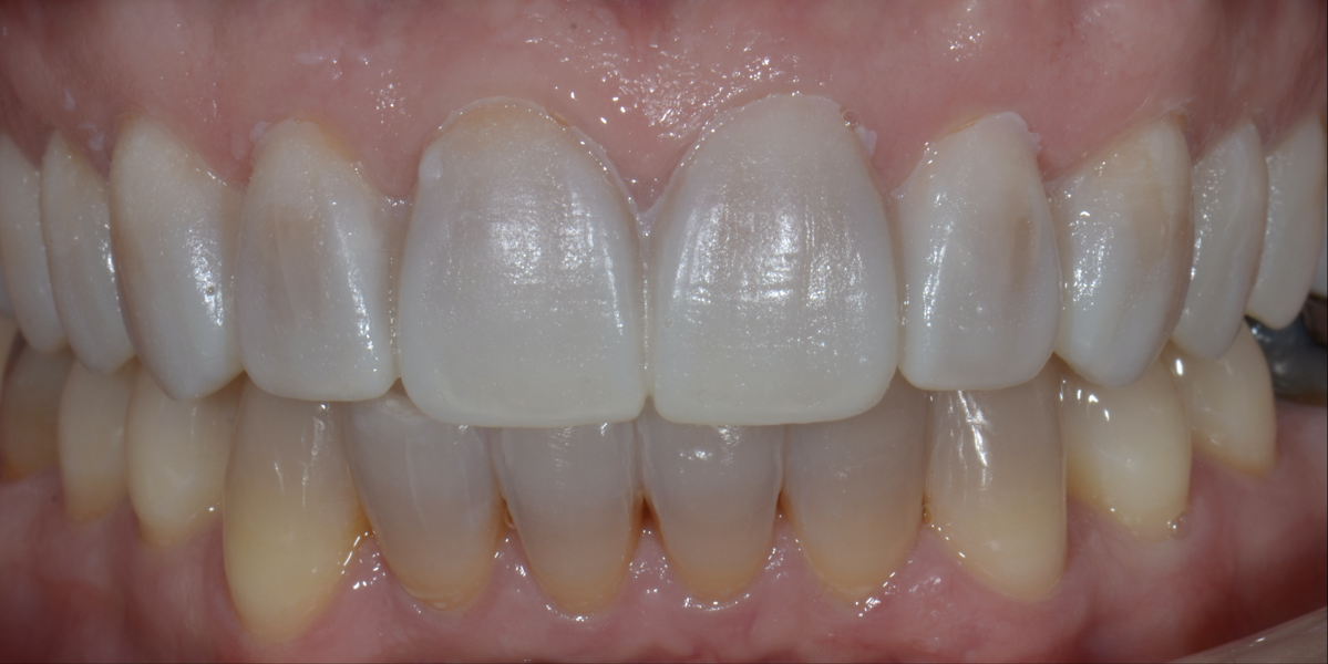 Fig. 5: Intra-oral view of the mock-up.