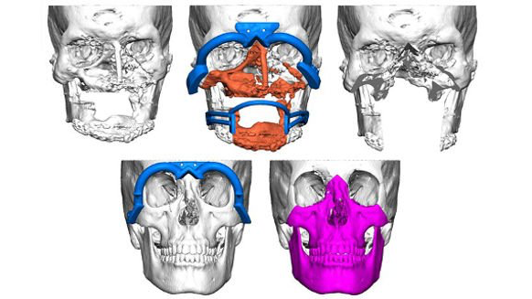 ProModel de Planmeca permite realizar el primer trasplante facial en países nórdicos