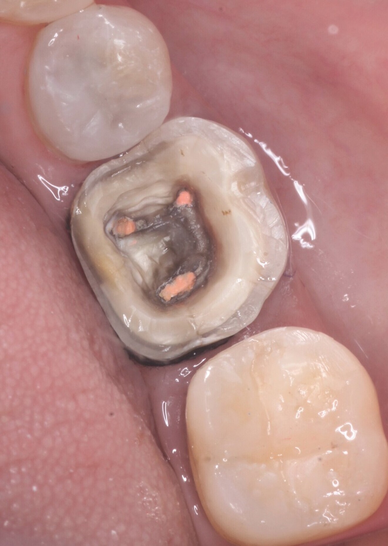 Fig. 7: Tooth #46 before the intra-oral scan.