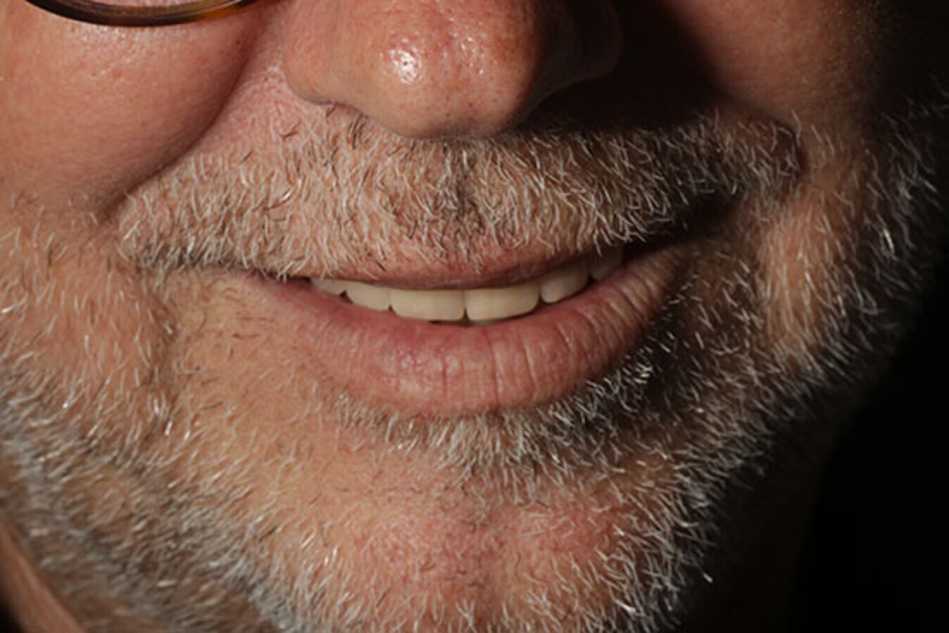 Fig. 26. Imagen extraoral de la sonrisa del paciente. 