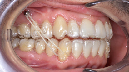 Mandibular occlusal plane management with micro-screws to correct an edge-to-edge incisal relationship