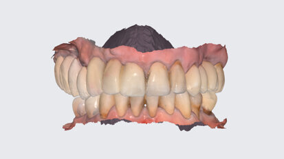 Guided implant placement and restoration: A comprehensive approach