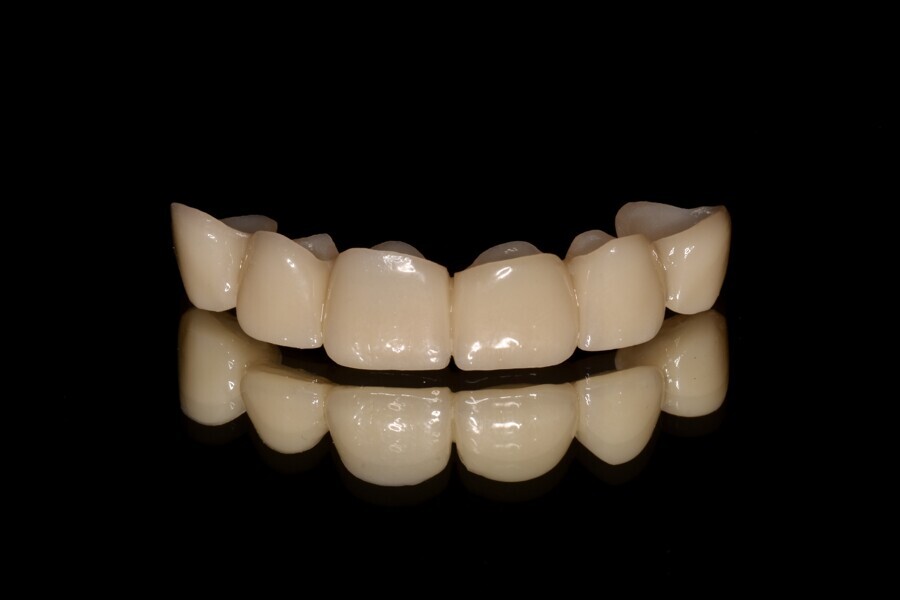 Fig. 10a: Provisional restorations after post-processing and high-gloss polishing. Detailed view of the maxillary anterior segment.