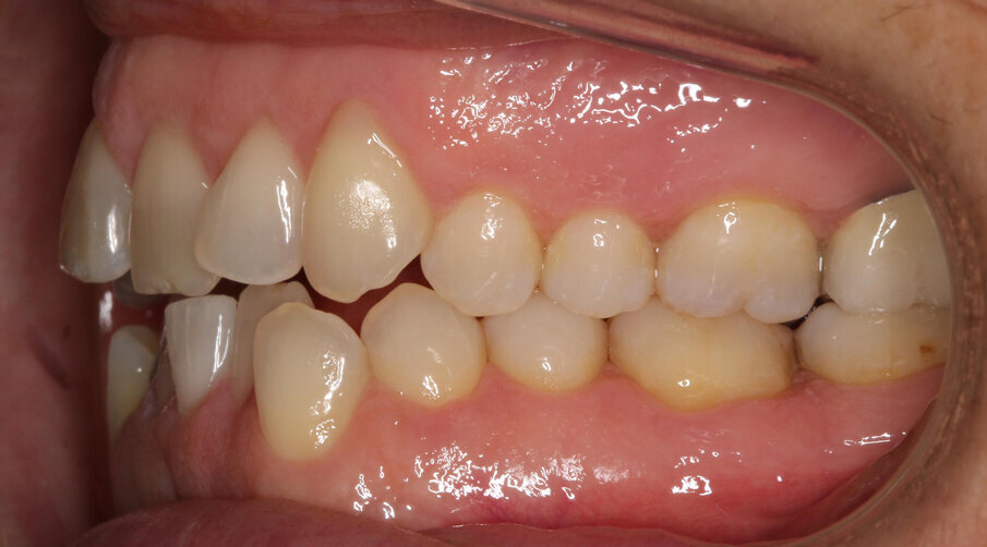 Pre-treatment