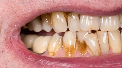 Cariogenic bacteria produce substance that aids calcium tolerance