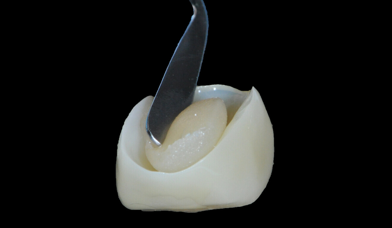 Fig. 21: Heated composite paste placed into the overlay. 