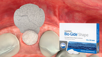 Geistlich Bio-Gide Shape: Preservazione della cresta minimamente invasiva in caso di difetti della parete vestibolare