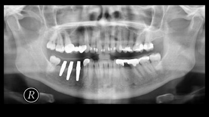 Metallfreie Implantate: Wunsch oder Wirklichkeit?