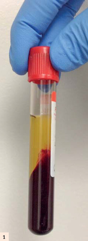 figure 1 : Tube pour A-PRF. La centrifugation lente de courte durée piège plus de cellules dans le caillot de fibrine.