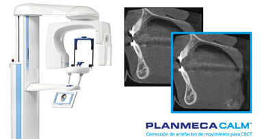 La excepcional calidad de imagen de las unidades CBCT de Planmeca