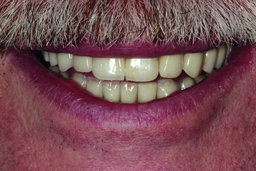 Fig. 28: Patient’s smile at the end of
the treatment.