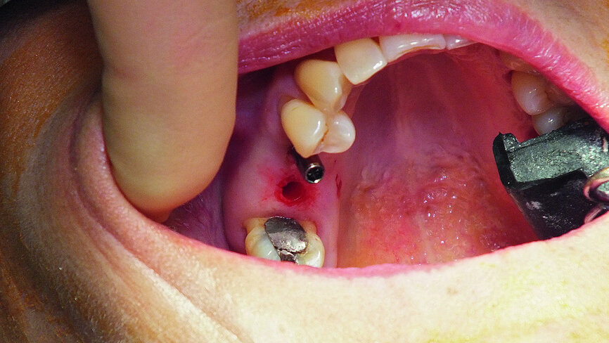 Fig. 12: The NaviStent was removed and the site was prepared for the internal sinus lift.