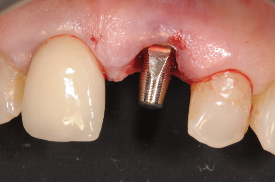 Fig. 5 - A preparazione del sito impiantare ultimata abbiamo inserito un analogo dell’impianto per stabilire l’altezza del moncone da utilizzare.