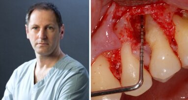 Terapia rigenerativa di un difetto infraosseo con approccio mini invasivo