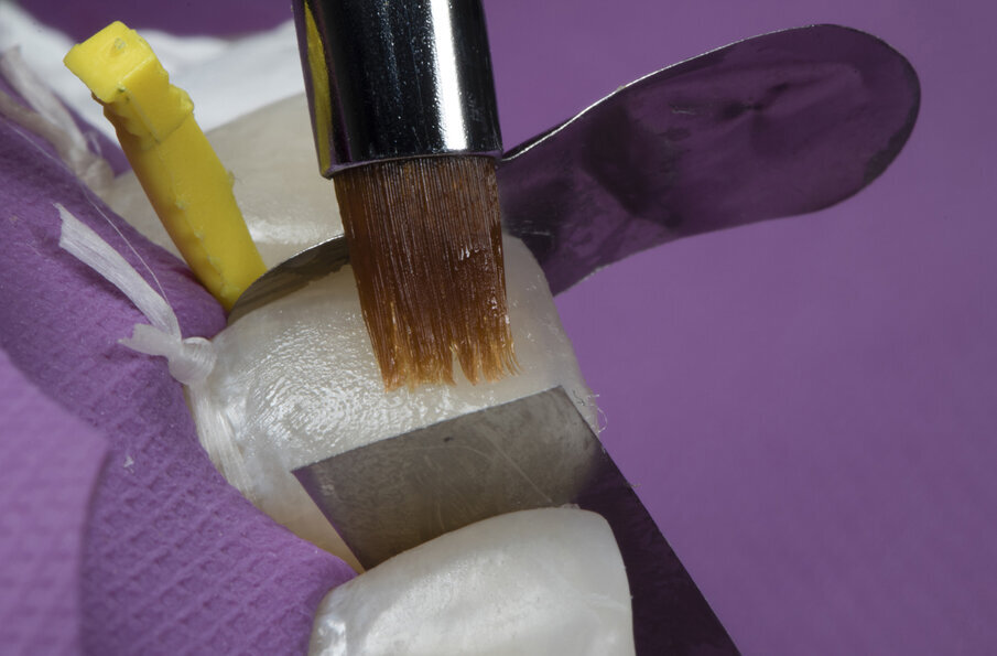 Fig. 11: Final enamel layer build-up with Beautifil II Enamel shade HVT of achieve high-value translucency and finished with an art brush in horizontal motion strokes