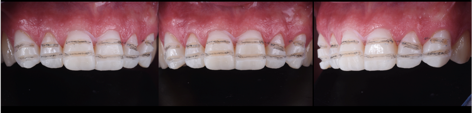 Figs. 9a–f: Guiding grooves for preparation.