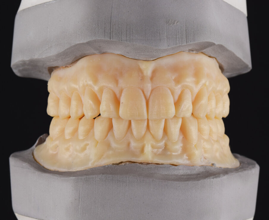 Fig. 12: Modified wax try-ins (V-Print Try-In).