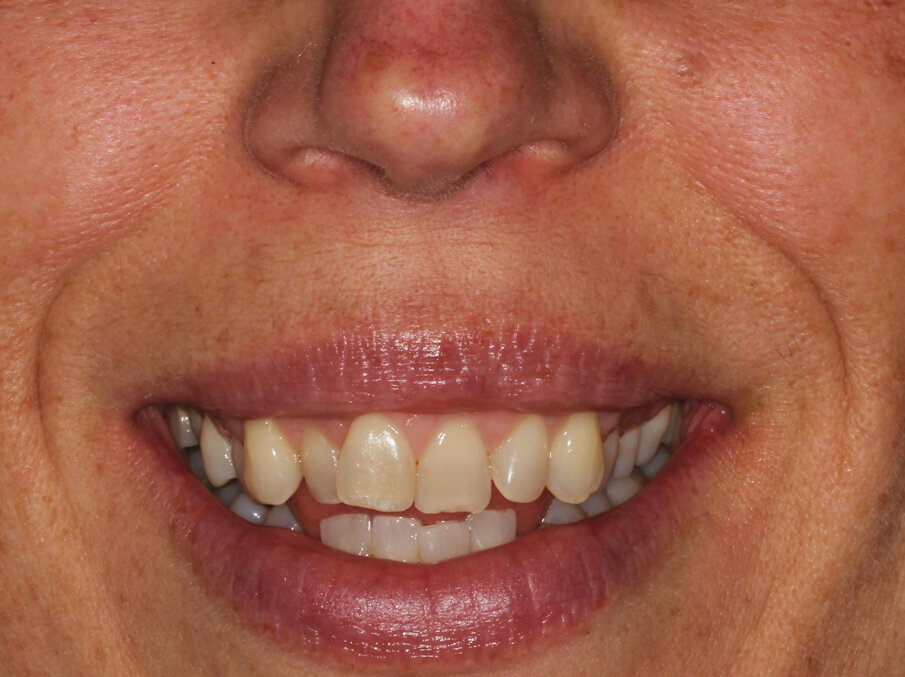 Pre-treatment