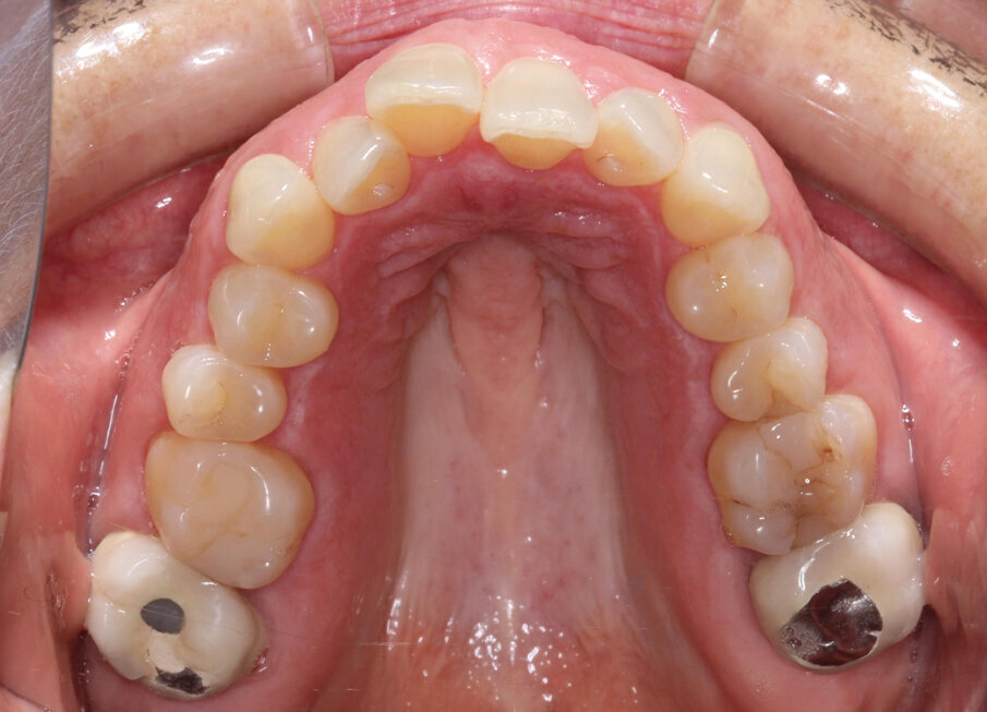 Pre-treatment
