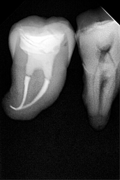 Fig. 35: Radiograph after completion of the restoration.